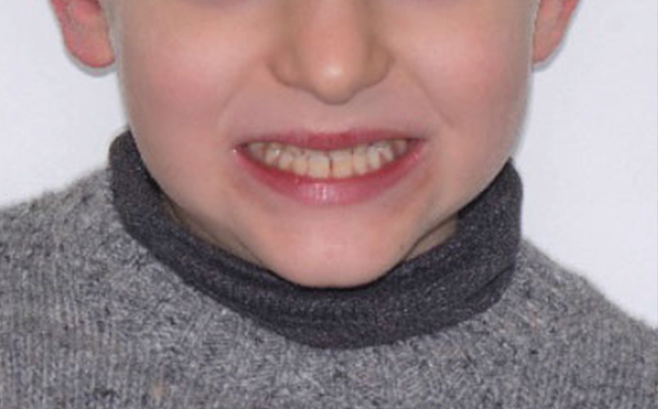 Early Treatment of Anterior Crossbite in a Growing Patient